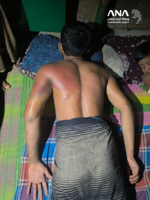 Injuries to the body of one of the kidnapped Rohingyas (Image: ANA)